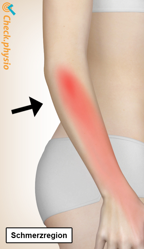 arm Radialtunnelsyndrom Lokation