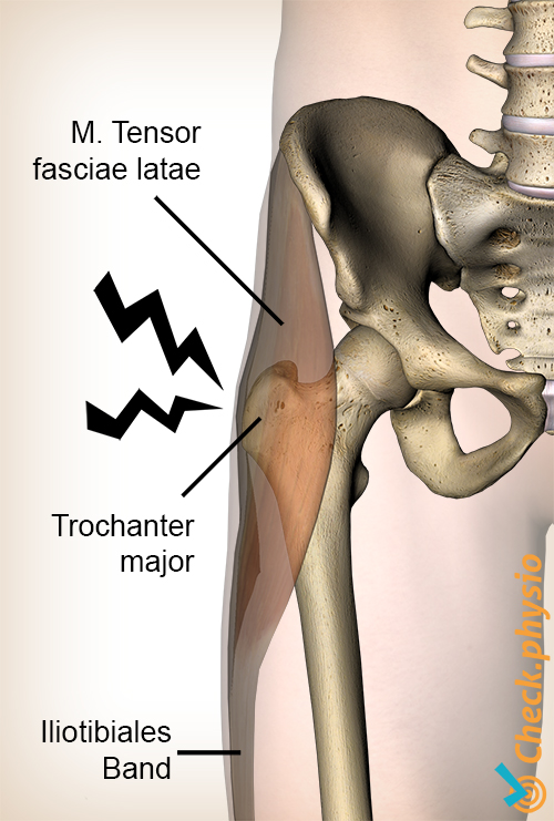 Hüft Trochanter Major Schmerzsyndrom Anatomie Tensor Fasciae Latae Tractus Iliotibialis