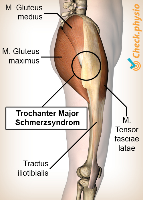 Hüft Trochanter Major Schmerzsyndrom Anatomie