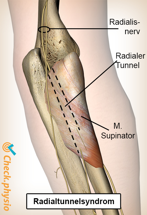 arm Radialtunnel Nervus radialis