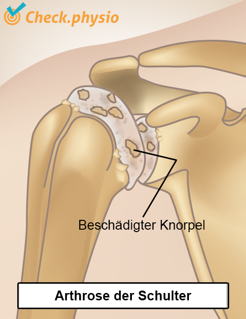 Schulter Arthrose