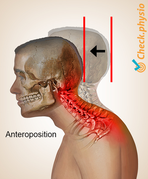 Kopf Nacken Zervikales Haltungssyndrom Anteroposition