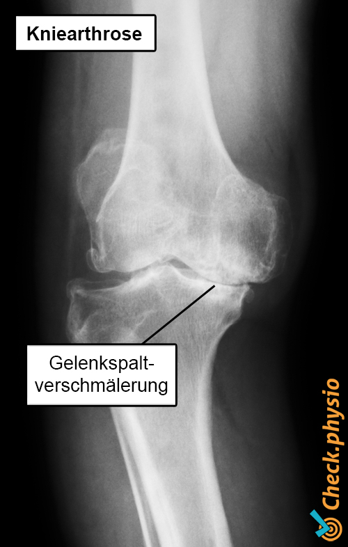 Kniearthrose Röntgenbild