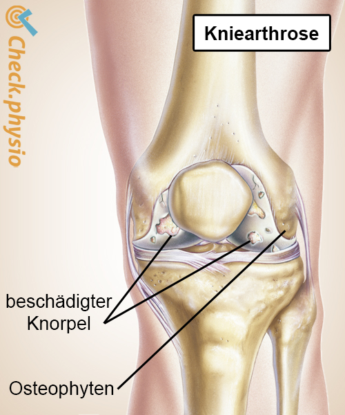 Knie Arthrose Abnutzung Knorpel