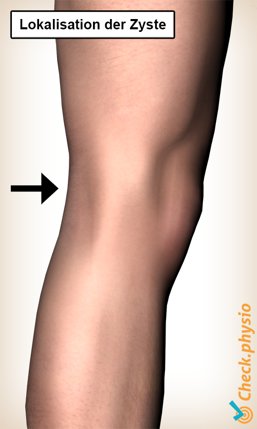 Knie Bakers Zyste Lage Kniekehle