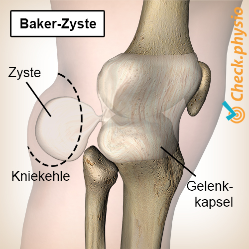 Knie Bakers Zyste Popliteale Zyste