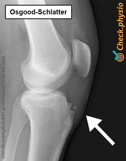 Knie Osgood Schlatter Röntgenbild