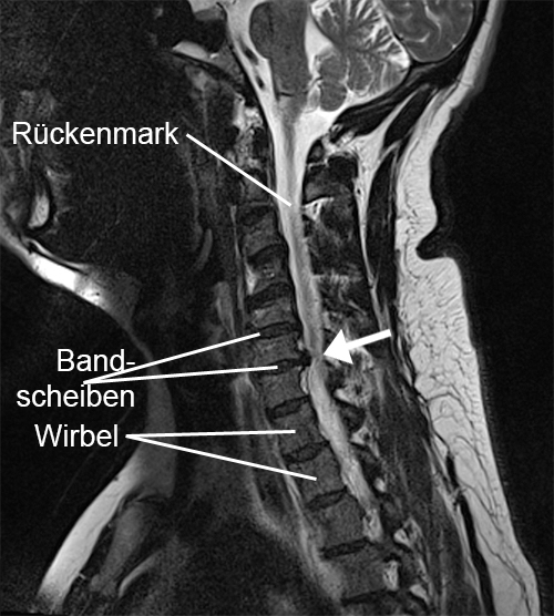 Nacken Zervikale Radikulopathie weicher Bandscheibenvorfall