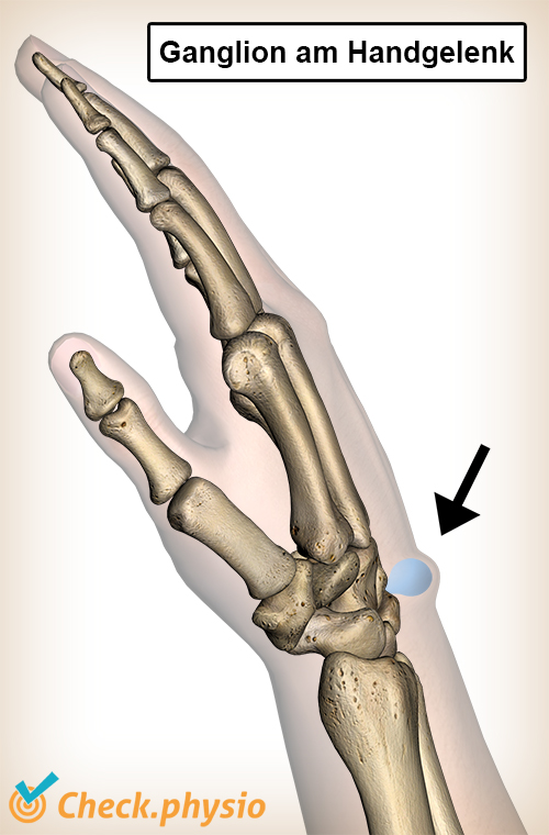 Handgelenksganglion Schwellung Beule Anatomie Schleimzyste Mukoidzyste