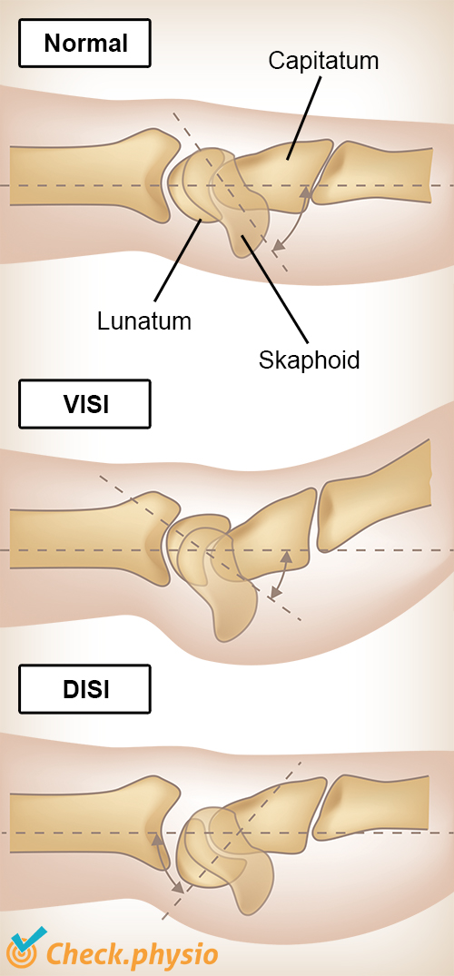 Handgelenk VISI DISI