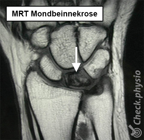 Handgelenk Kienböck-Erkrankung MRI Os lunatum