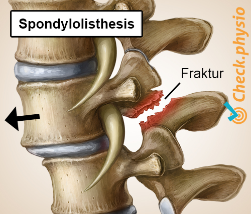 rückenspezifische untere Rückenschmerzen Spondylolisthesis verschobener Wirbel