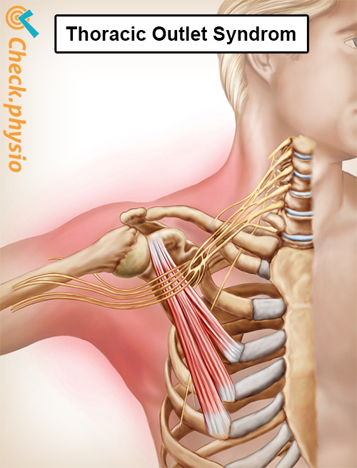 Schulter Arm Hand Thoracic Outlet Syndrom Anatomie