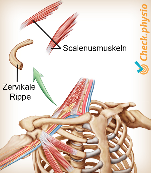 Schulter Arm Hand TOS Thoracic Outlet Syndrom Halsrippe
