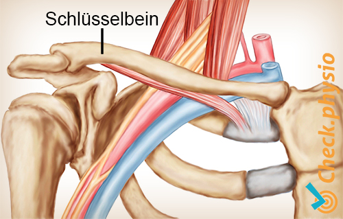 Schulter Arm Hand TOS Thoracic Outlet Syndrom Schlüsselbein
