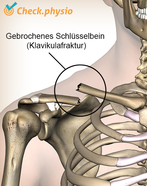 Schulter Klavikulafraktur gebrochenes Schlüsselbeinbruch