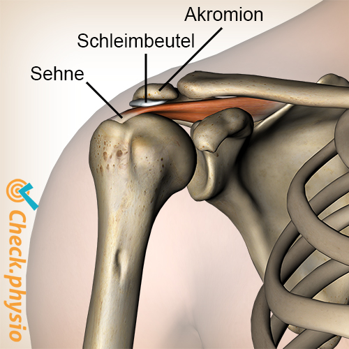 Schulterimpingement Schleimbeutel Bursa Supraspinatus