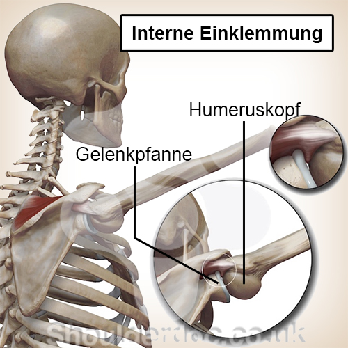 Schulter intern Impingement Schulterkopf Schulterpfanne Einklemmung
