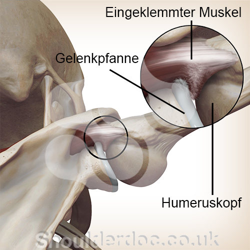 Schulter intern Impingement Schulterkopf Schulterpfanne Zoom Einklemmung