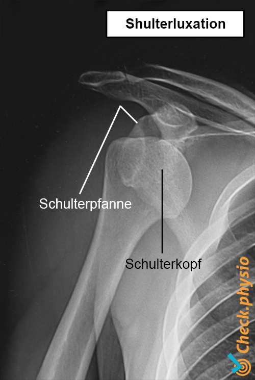 Schulter Röntgen Luxation