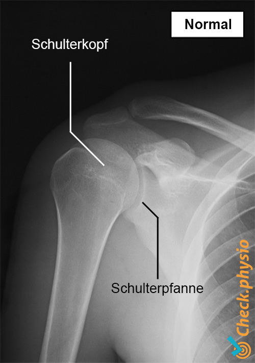 Schulter Röntgen normal