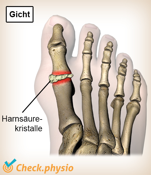 Zeh Gicht Harnsäurekristalle