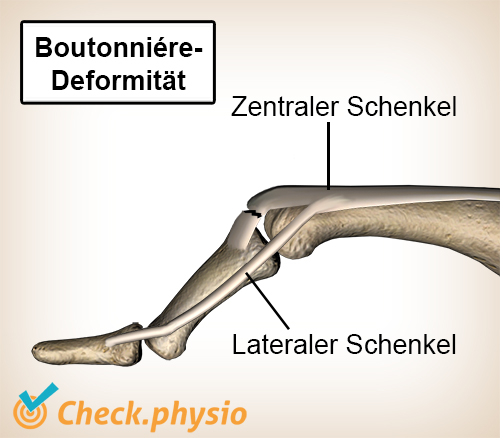 Finger Boutonniere-Deformität Strecksehne Seitenband Zentralband