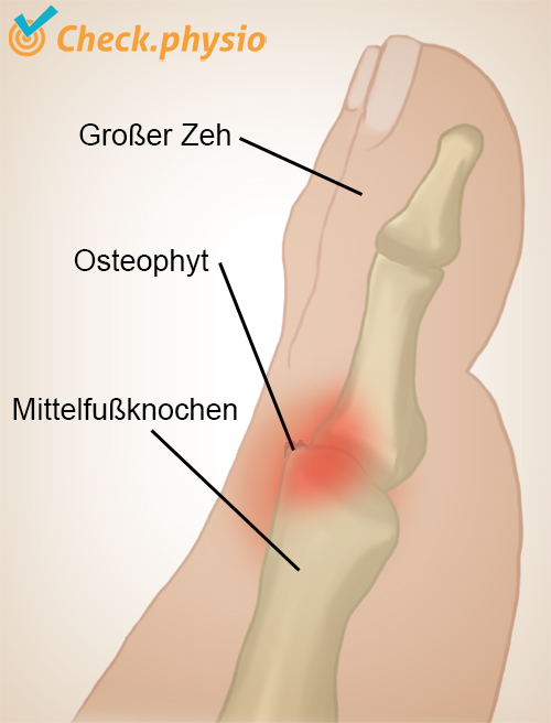 Fuß Hallux Rigidus Osteophytenbildung