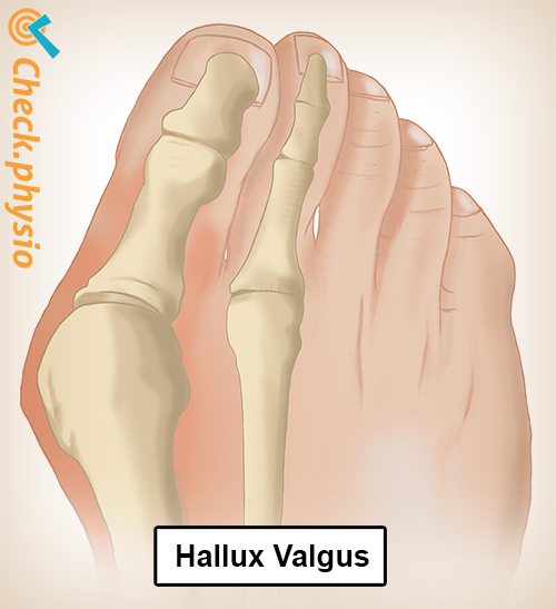 Fuß Hallux Valgus Anatomie
