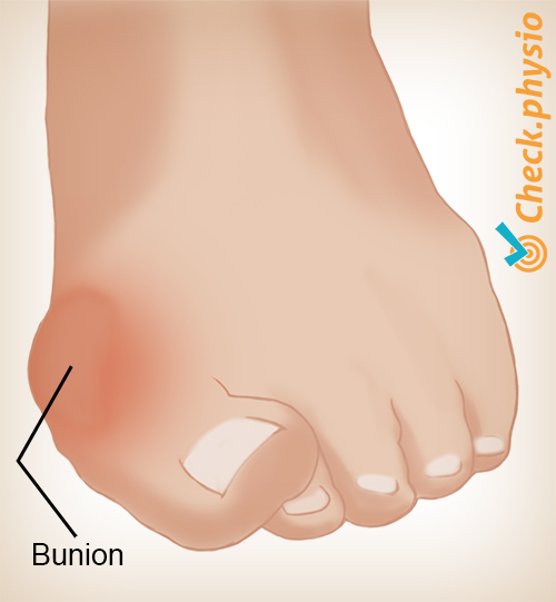 Fuß Hallux Valgus Ballen