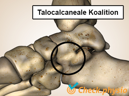 Fuß Talokalkaneale Koalition