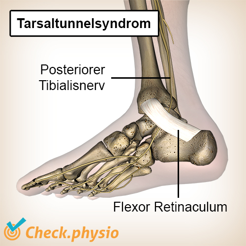 Fuß Tarsaltunnelsyndrom Nervus Tibialis posterior Retinaculum flexorum