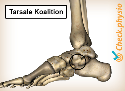 Fuß Tarsale Koalition medial Innenseite
