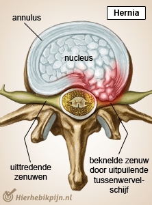 Wirbelsäule Wirbel Bandscheibe Hernie Nerven