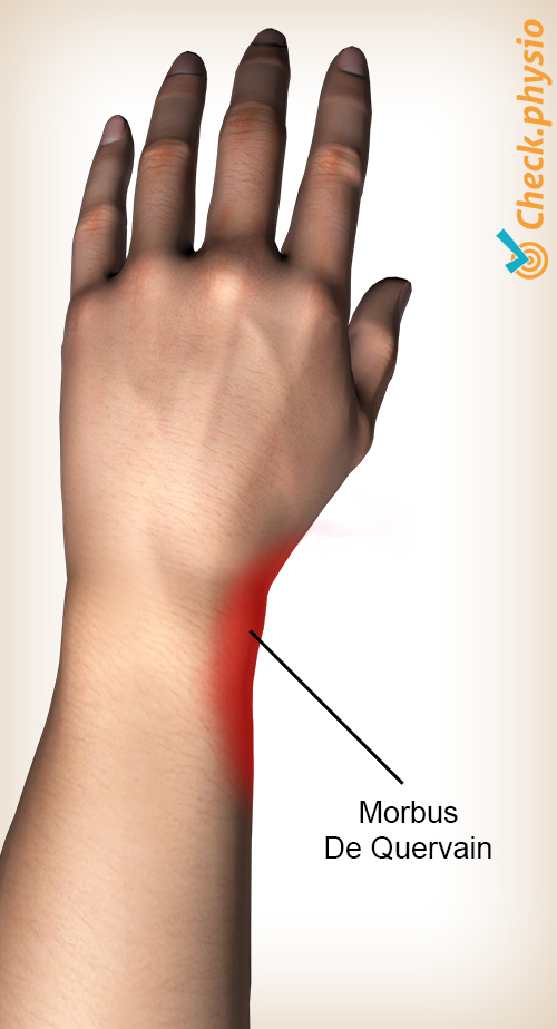 arm De Quervain Lokalisation