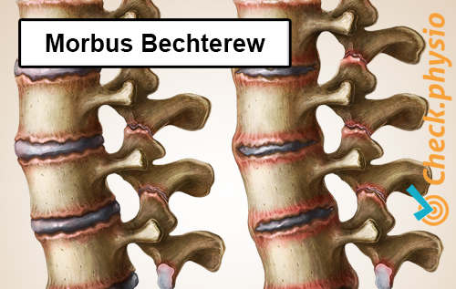 rückenspezifische untere Rückenschmerzen Morbus Bechterew Spondylitis Ankylosans