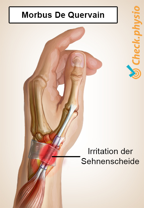 Arm De Quervain
