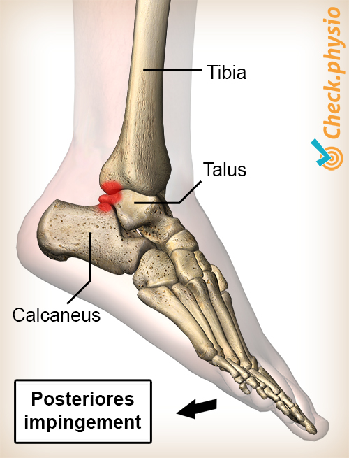 Sprunggelenk hinteres Impingement Plantarflexion