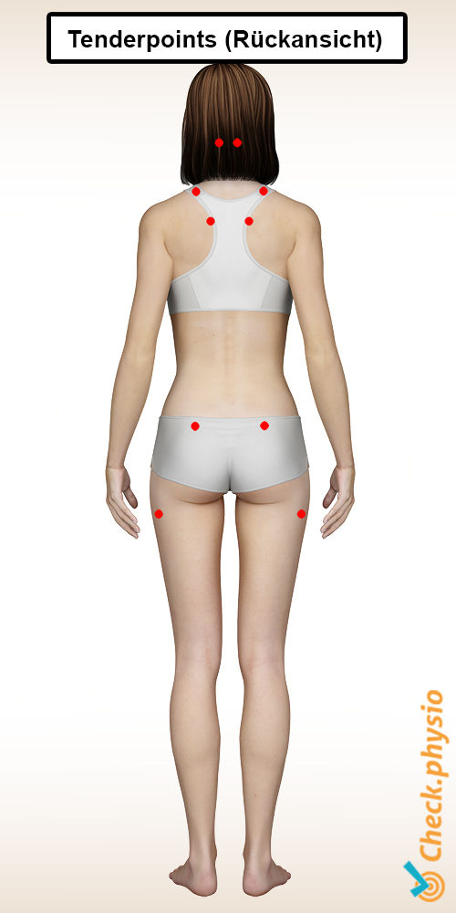 Fibromyalgie Tenderpoints hinten