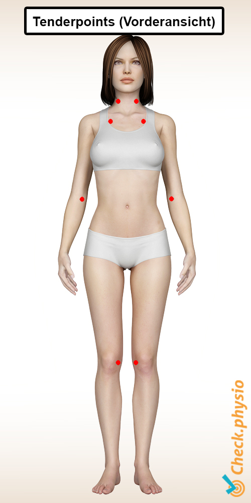 Fibromyalgie Tenderpoints vorne