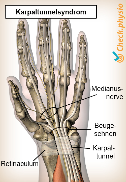 hand Karpaltunnelsyndrom Karpale Einklemmung