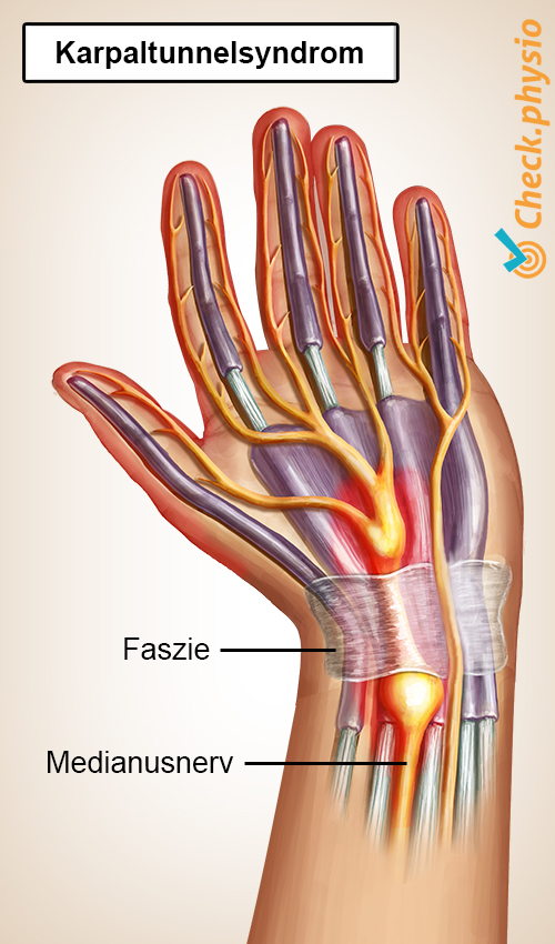 Hand Karpaltunnelsyndrom KTS Nervus medianus Einklemmung