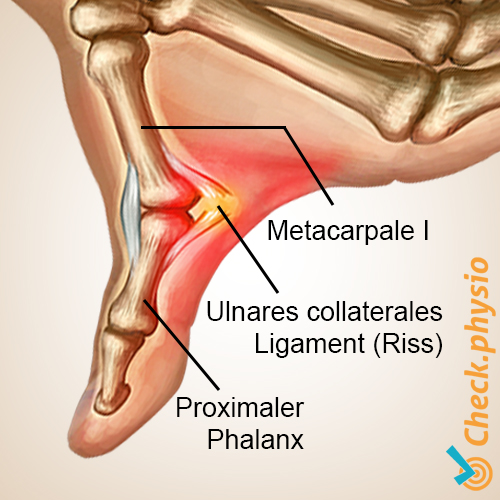 Hand Skidaumen Anatomie Ligamentum Collaterale ulnare