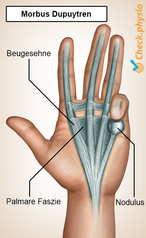 Hand Dupuytren-Krankheit Aponeurosis palmaris Knoten