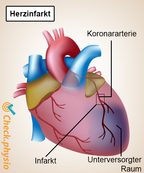 Herz Herzinfarkt Koronararterie Anatomie