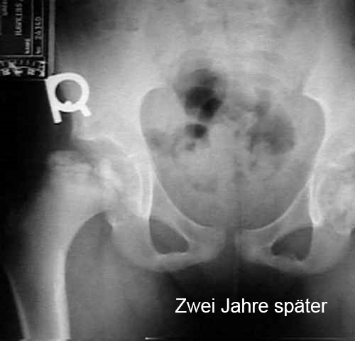 Hüfte Calvé-Legg-Perthes Altes 8