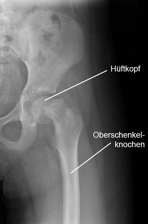 Hüfte Epiphysiolysis Capitis Femoris Röntgen