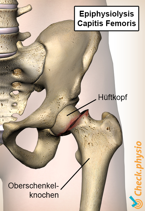 Hüfte Epiphysiolysis Capitis Femoris